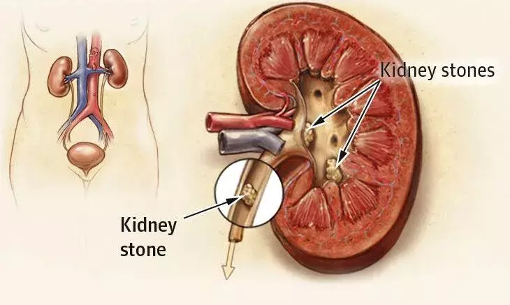स्टोन निकलवाने गए युवक की निकाल ली किडनी, हंगामा बढ़ा तो दी सफाई साथ ही 10 लाख का ऑफर.....