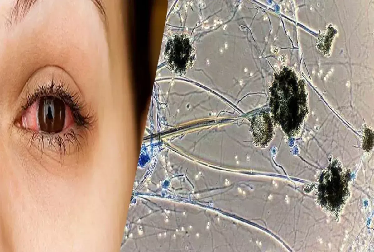 लखनऊ में ब्लैक फंगस के कारण महिला की मृत्यु- चिकित्सकों ने बताए शरीर में उत्पन्न होने वाले लक्षण....