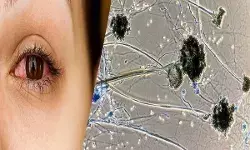 ब्लैक फंगस के चौंकाने वाले मामले, न डायबिटीज और न ही अस्पताल में हुए भर्ती फिर भी ब्लैक फंगस की चपेट में......