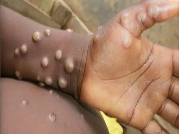 To combat the monkeypox outbreak, review the Union Governments advice