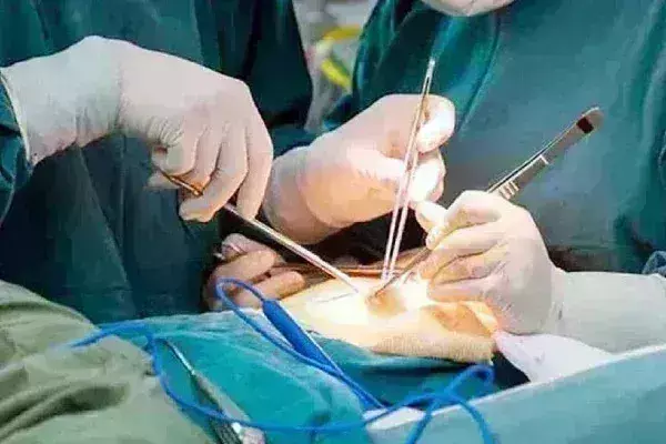 युवती की किडनी से निकाले 300 स्टोन:बबल टी और शराब ने करा दिया कांड!