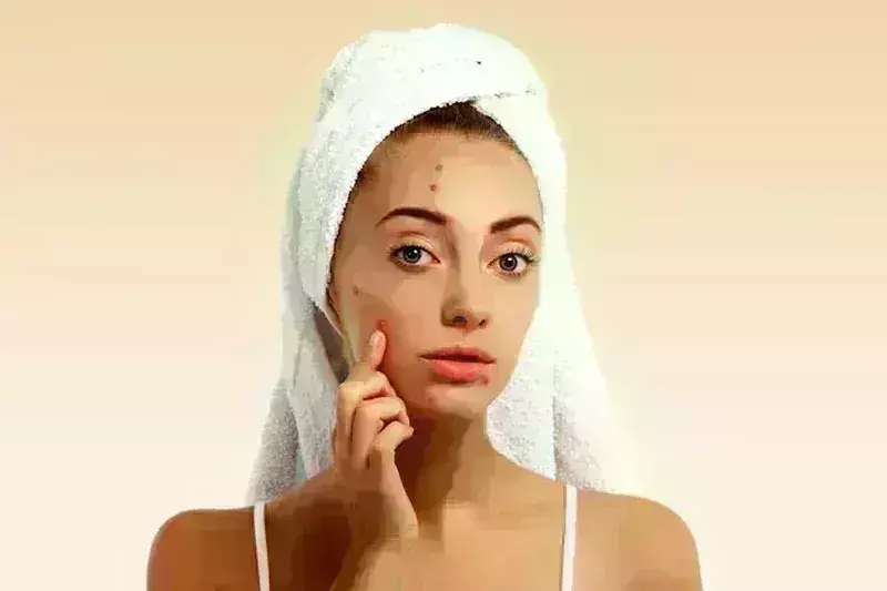 पीसीओएस के वजह से चेहरे पर निकल रहे हैं मुहांसे तो जानें कैसे करें कंट्रोल पीसीओएस के वजह से चेहरे पर निकल रहे हैं मुहांसे तो जानें कैसे करें कंट्रोल