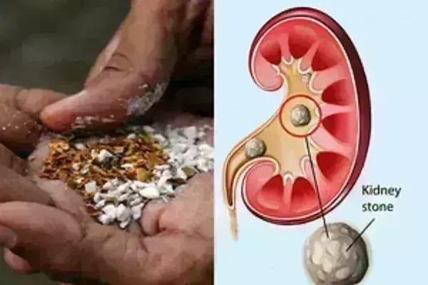 गुर्दे की बड़ी पथरी का कारण बन सकता है पान मसाला : विशेषज्ञ