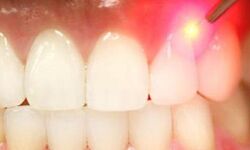 दांतो में संवेदनशीलता ! ठंडा और गरम खाने में असुविधा