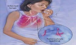 सरकार का नया अभियान, टी.बी हारेगा देश जीतेगा !