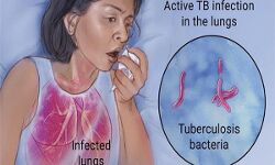 рдЯреНрдпреВрдмрд░рдХреНрд▓реЛреЗрд╕рд┐рд╕ рдХреЛ рдЬрдиреНрдо рджреЗрддреА рд╣реИрдВ ,рдЖрдкрдХреА рдЦрд░рд╛рдм рдЖрджрддреЗрдВ рдЯреНрдпреВрдмрд░рдХреНрд▓реЛреЗрд╕рд┐рд╕ рдХреЛ рдЬрдиреНрдо рджреЗрддреА рд╣реИрдВ ,рдЖрдкрдХреА рдЦрд░рд╛рдм рдЖрджрддреЗрдВ