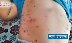 рд╕реНрдХреНрд░рдм рдЯрд╛рдЗрдлрд╕ : рдпрд╣ рдмреАрдорд╛рд░реА рд╣реИ рдШрд╛рддрдХ , рдЬрд╛рдирд┐рдП рд▓рдХреНрд╖рдг рдФрд░ рдХрд╛рд░рдг рд╕реНрдХреНрд░рдм рдЯрд╛рдЗрдлрд╕ : рдпрд╣ рдмреАрдорд╛рд░реА рд╣реИ рдШрд╛рддрдХ , рдЬрд╛рдирд┐рдП рд▓рдХреНрд╖рдг рдФрд░ рдХрд╛рд░рдг